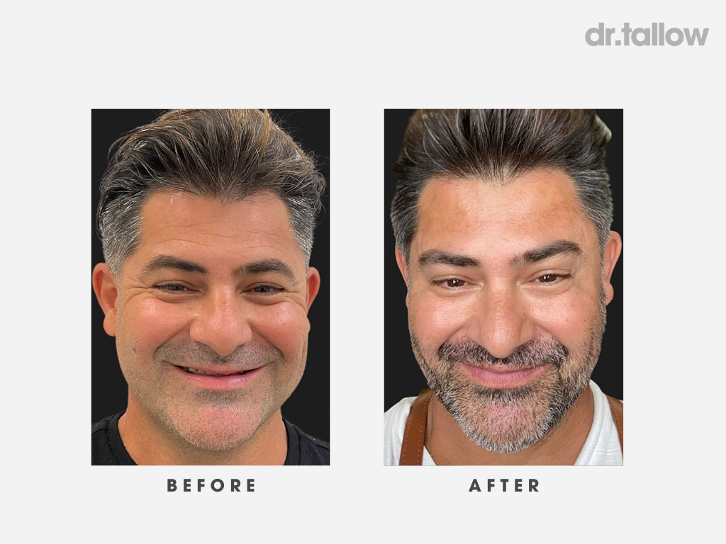 Anti-Aging Tallow Set Men